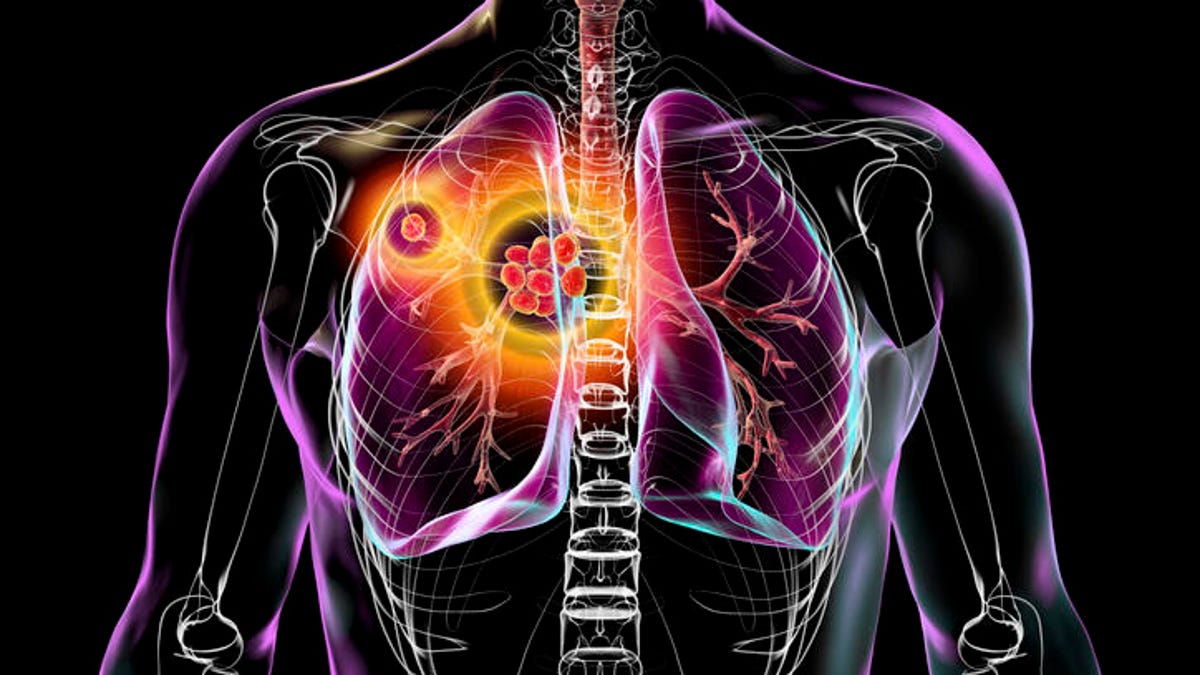 View of lungs tuberculosis
