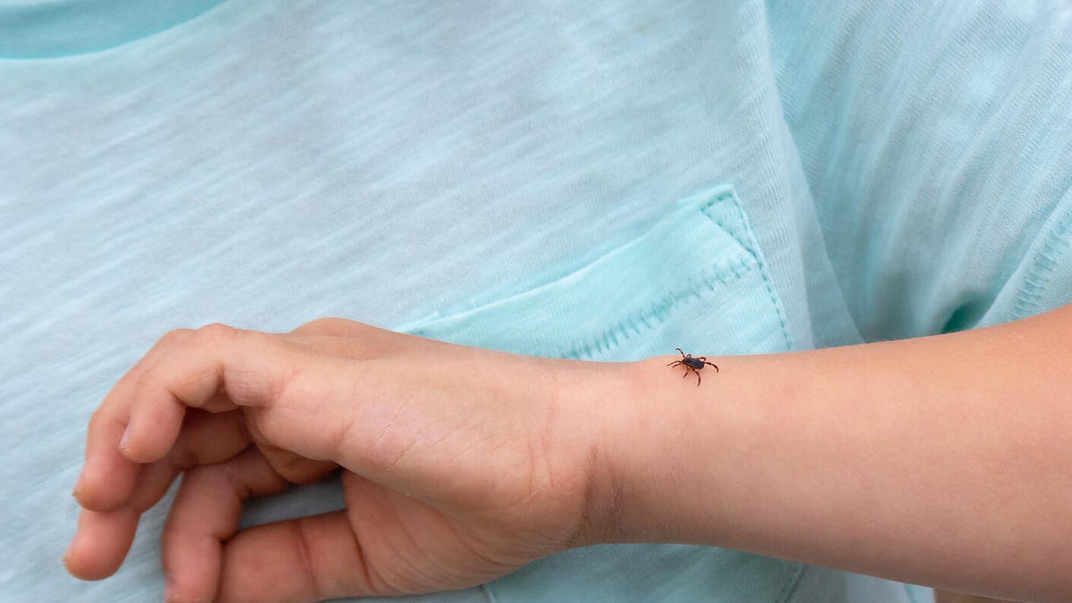 A tick on a little boy