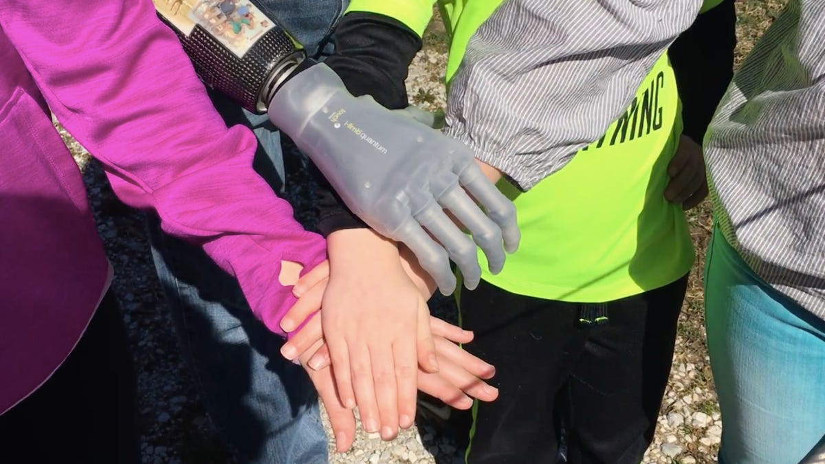 Jason Koger's i-limb