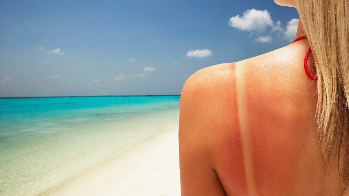 close-up of a woman's visible swimsuit line sunburn