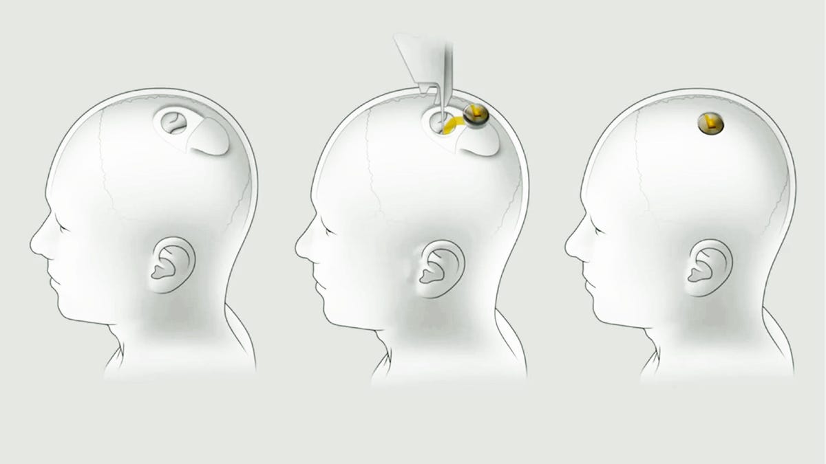 Neuralink's brain-machine interface technology sinks electrodes into the brain then uses a chip to communicate with computers outside your skull.